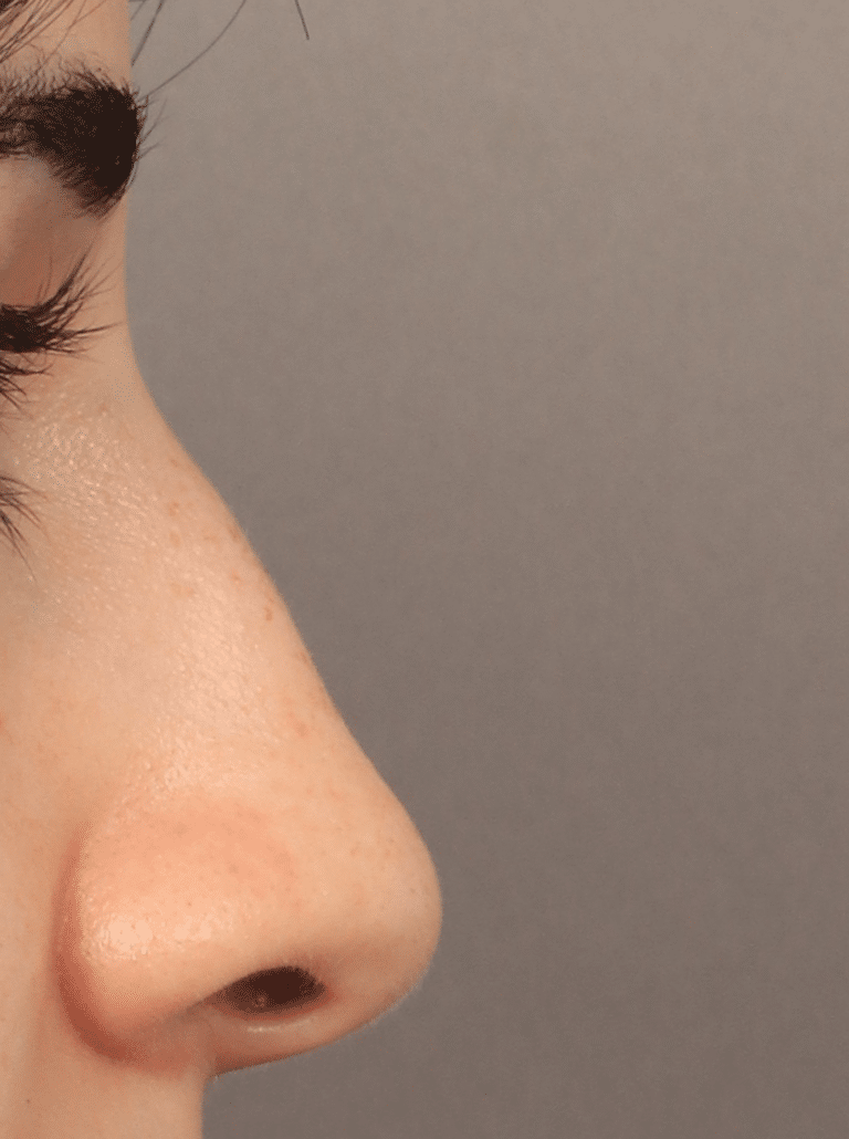 Before Image: Rhinoplasty, Alarplasty, & Septoplasty with PDS plate (3.5 Months Post-op) - right-side