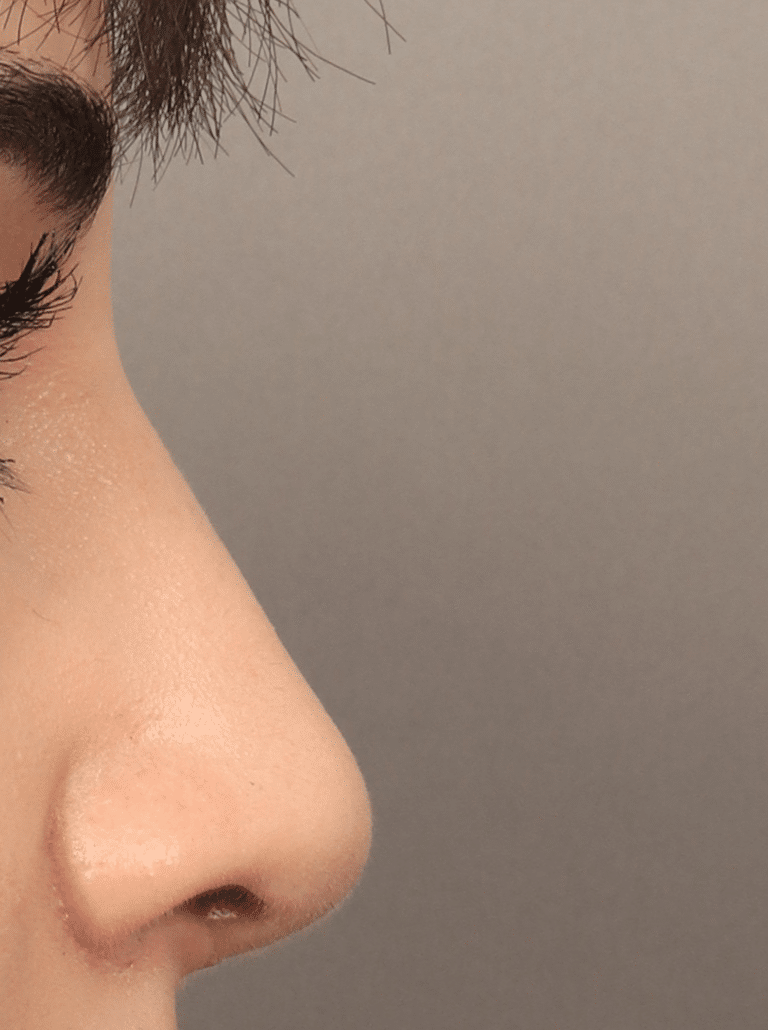 After Image: Rhinoplasty, Alarplasty, & Septoplasty with PDS plate (3.5 Months Post-op) - right-side