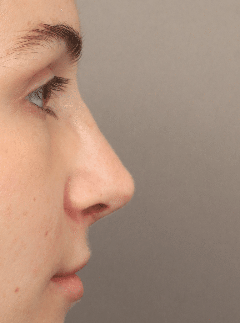 After Image: Rhinoplasty (9 Months Post-op) - right-side