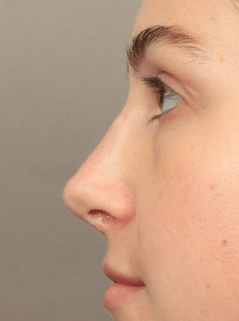After Image: Rhinoplasty (9 Months Post-op) - left-side