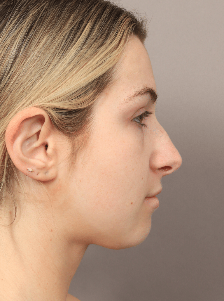 Before Image: Rhinoplasty (9 Months Post-op) - right-side