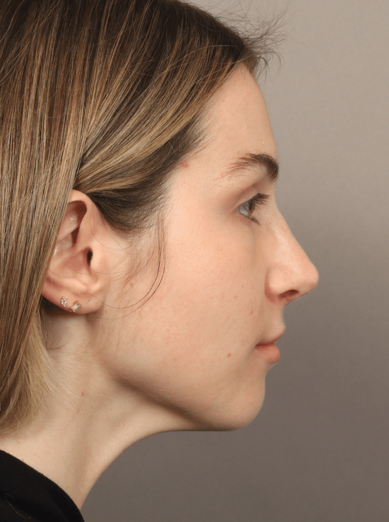 After Image: Rhinoplasty (9 Months Post-op) - right-side