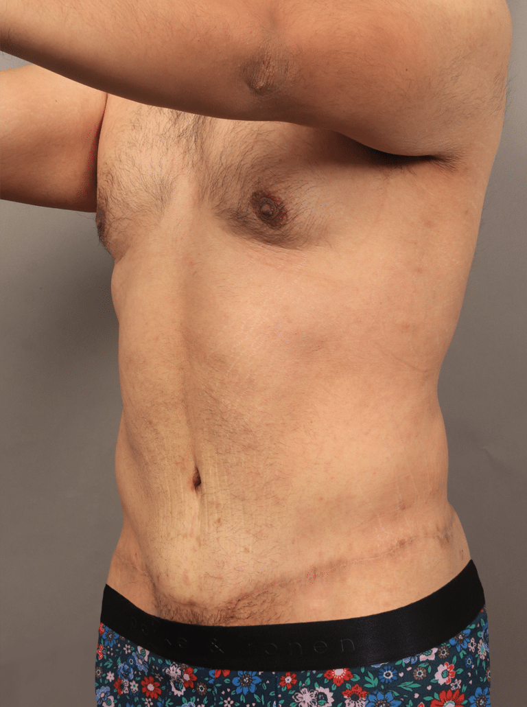After Image: Post Massive Weight Loss: Circumferential Toroplasty with Liposuction & Renuvion Skin Tightening (1 Year Post-op) - left-front-oblique
