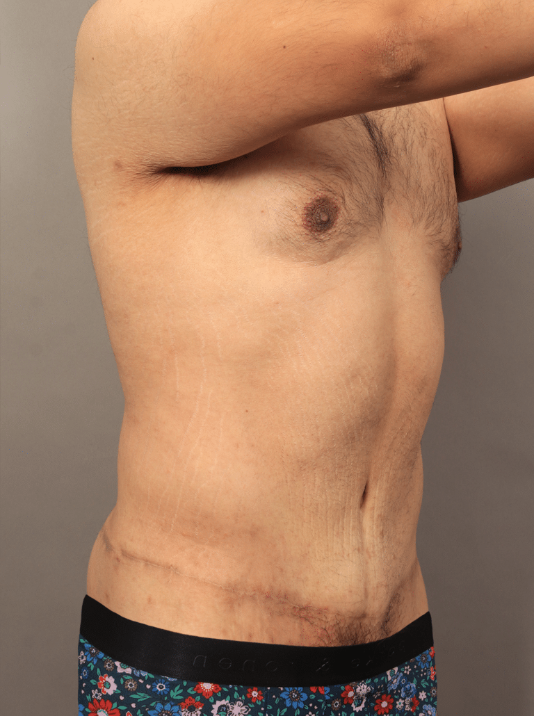 After Image: Post Massive Weight Loss: Circumferential Toroplasty with Liposuction & Renuvion Skin Tightening (1 Year Post-op) - right-front-oblique