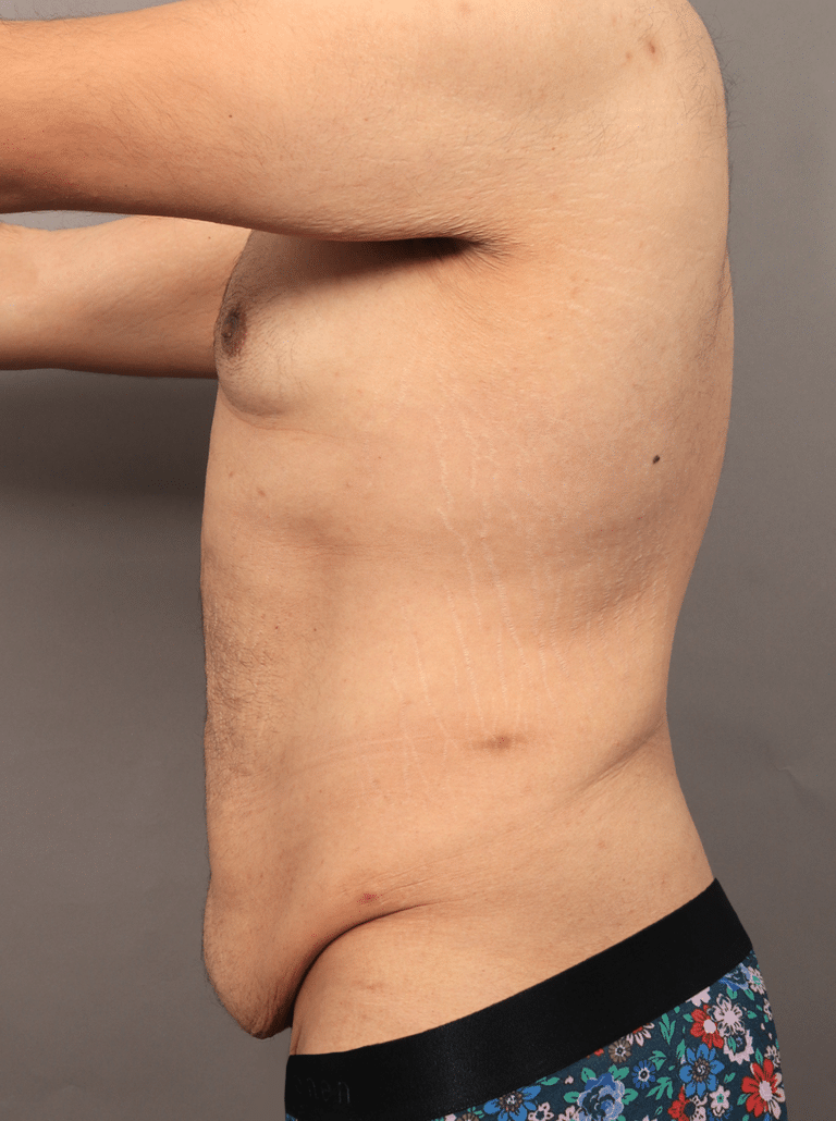 Before Image: Post Massive Weight Loss: Circumferential Toroplasty with Liposuction & Renuvion Skin Tightening (1 Year Post-op) - left-side