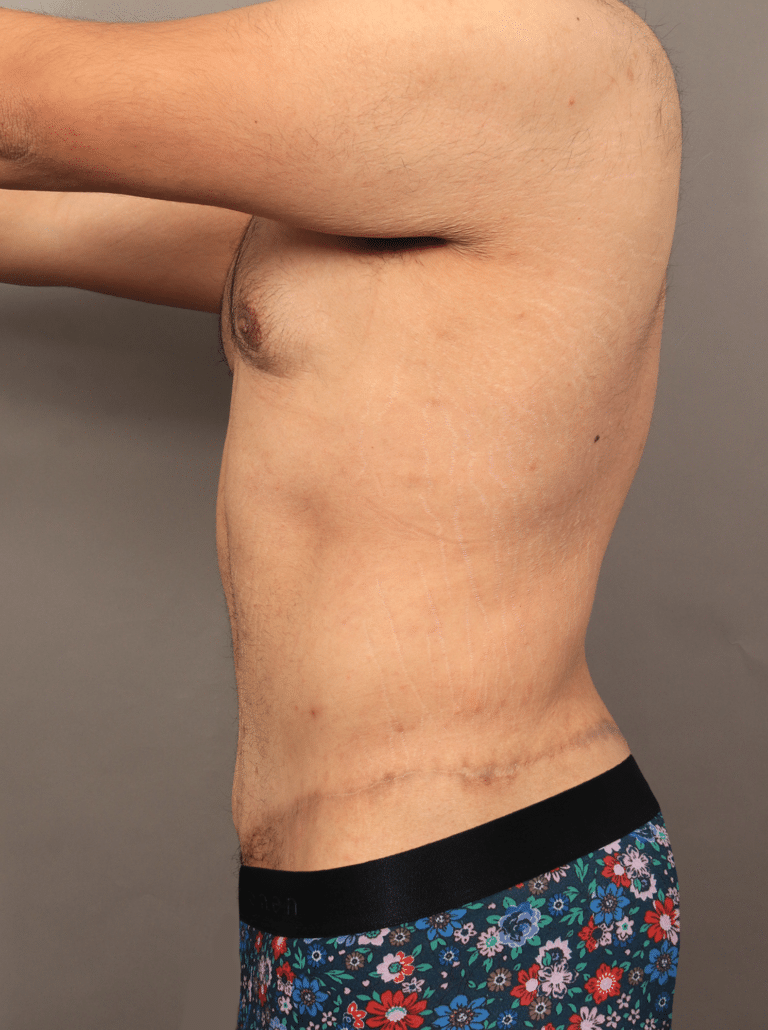 After Image: Post Massive Weight Loss: Circumferential Toroplasty with Liposuction & Renuvion Skin Tightening (1 Year Post-op) - left-side