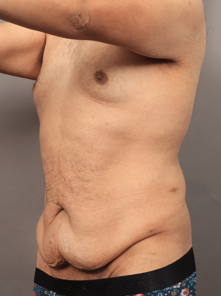 Before Image: Post Massive Weight Loss: Circumferential Toroplasty with Liposuction & Renuvion Skin Tightening (1 Year Post-op) - left-front-oblique