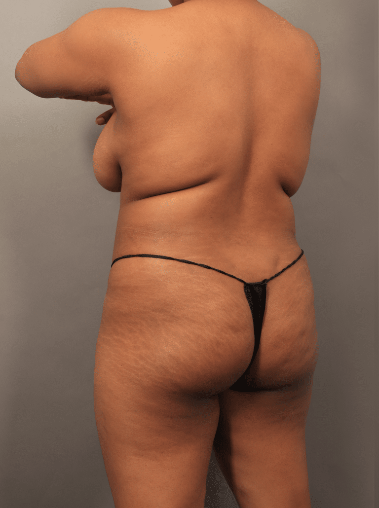 Before Image: VASER Liposuction with Fat Transfer to Hip Dips (1.5 Months Post-op) - left-back-oblique
