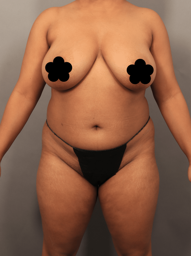 Before Image: VASER Liposuction with Fat Transfer to Hip Dips (1.5 Months Post-op) - front