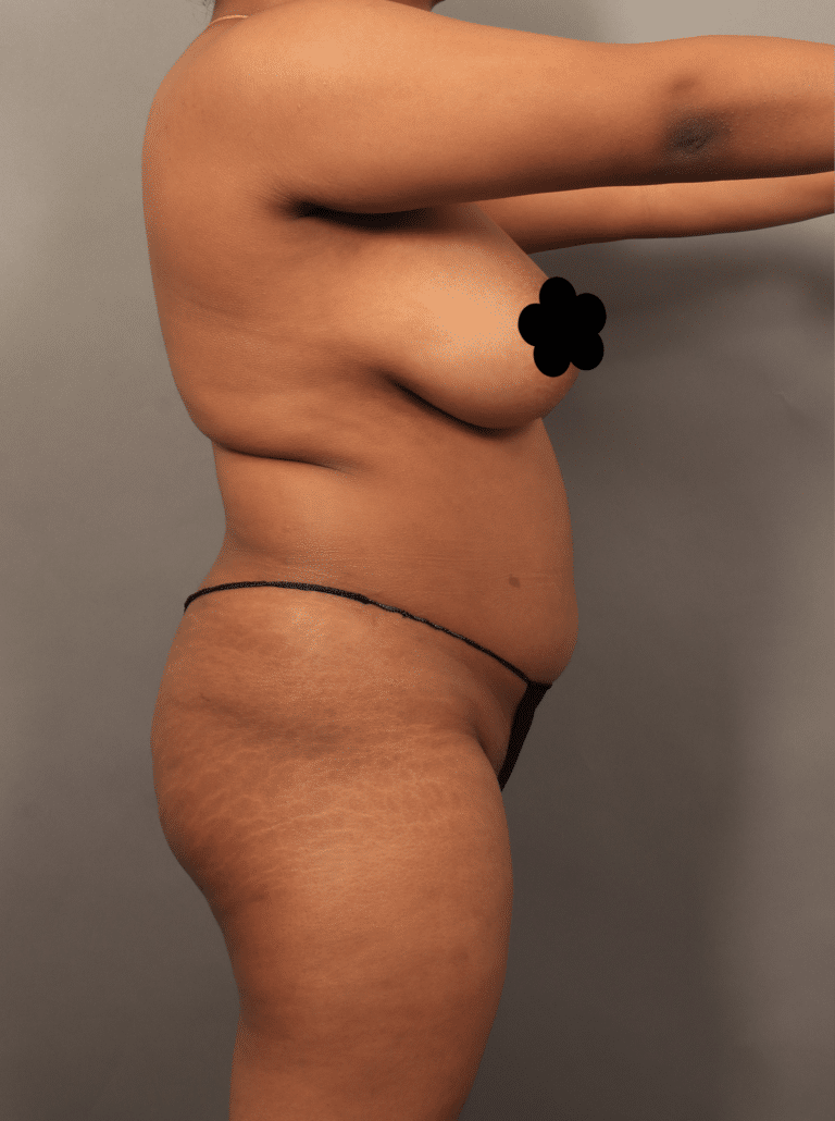 Before Image: VASER Liposuction with Fat Transfer to Hip Dips (1.5 Months Post-op) - right-side