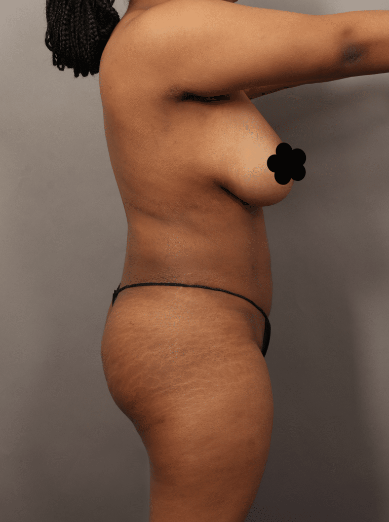 After Image: VASER Liposuction with Fat Transfer to Hip Dips (1.5 Months Post-op) - right-side