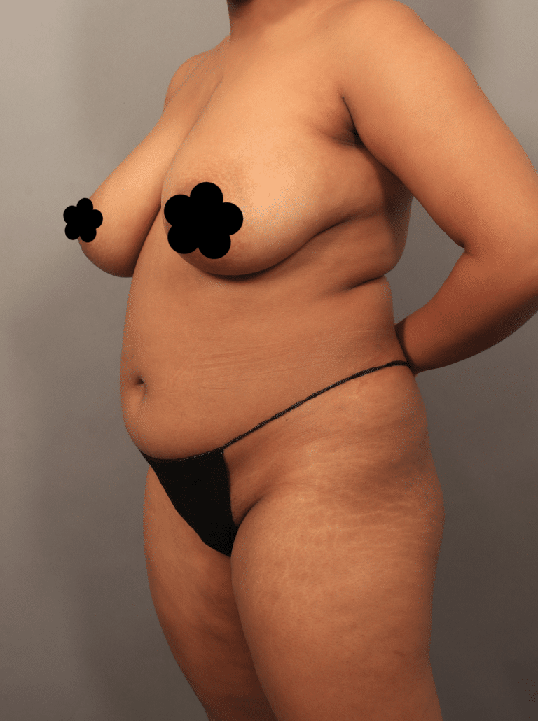 Before Image: VASER Liposuction with Fat Transfer to Hip Dips (1.5 Months Post-op) - left-front-oblique