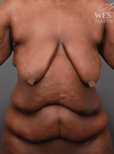Before Image: Post Weight Loss
