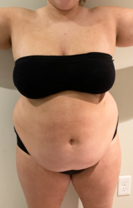 Before Image: Post Weight Loss