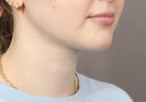 After Image: VASER Liposuction & Renuvion Skin Tightening (2 Months Post-Op)