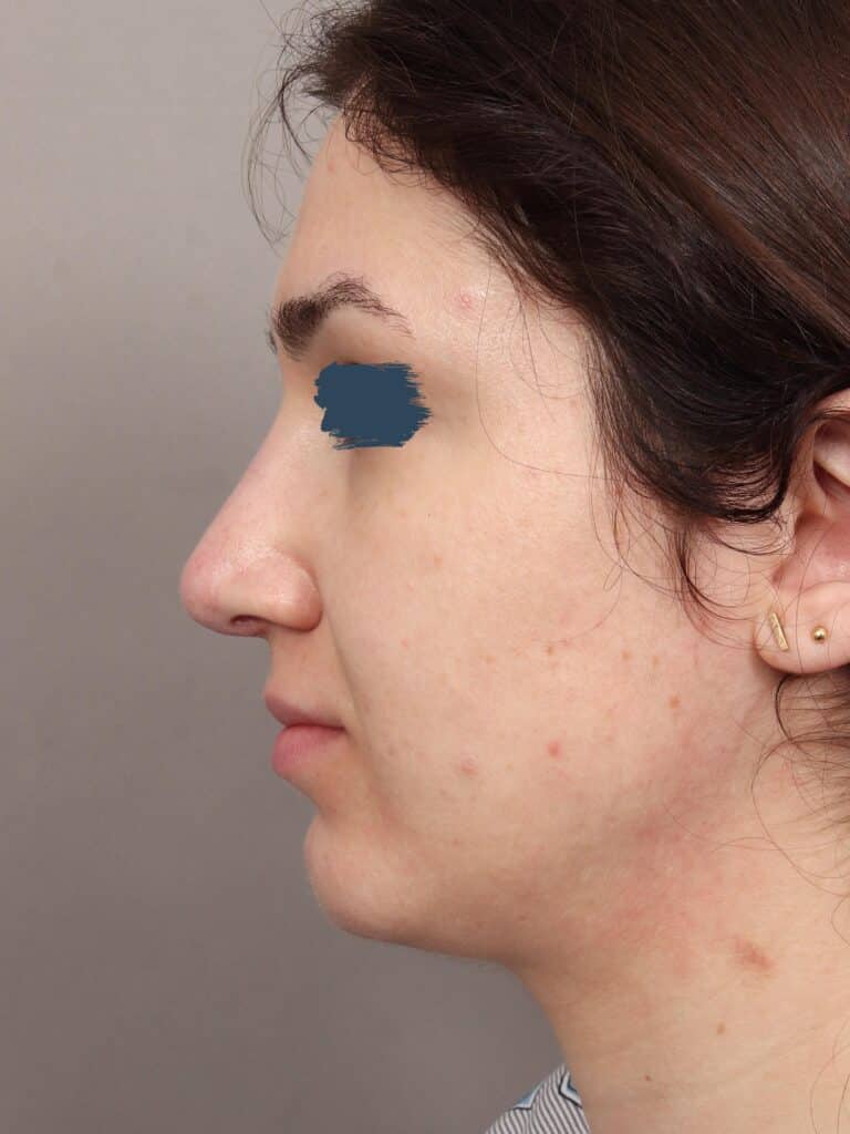 After Image: Rhinoplasty & Genioplasty (5 Months Post-Op) - left-side