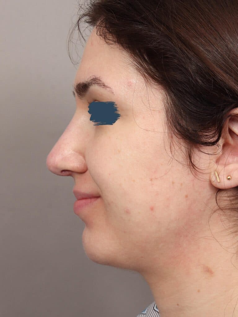 After Image: Rhinoplasty & Genioplasty (5 Months Post-Op) - left-side