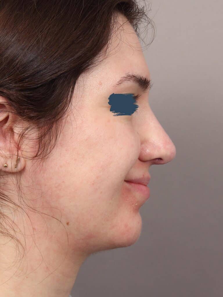After Image: Rhinoplasty & Genioplasty (5 Months Post-Op) - right-side