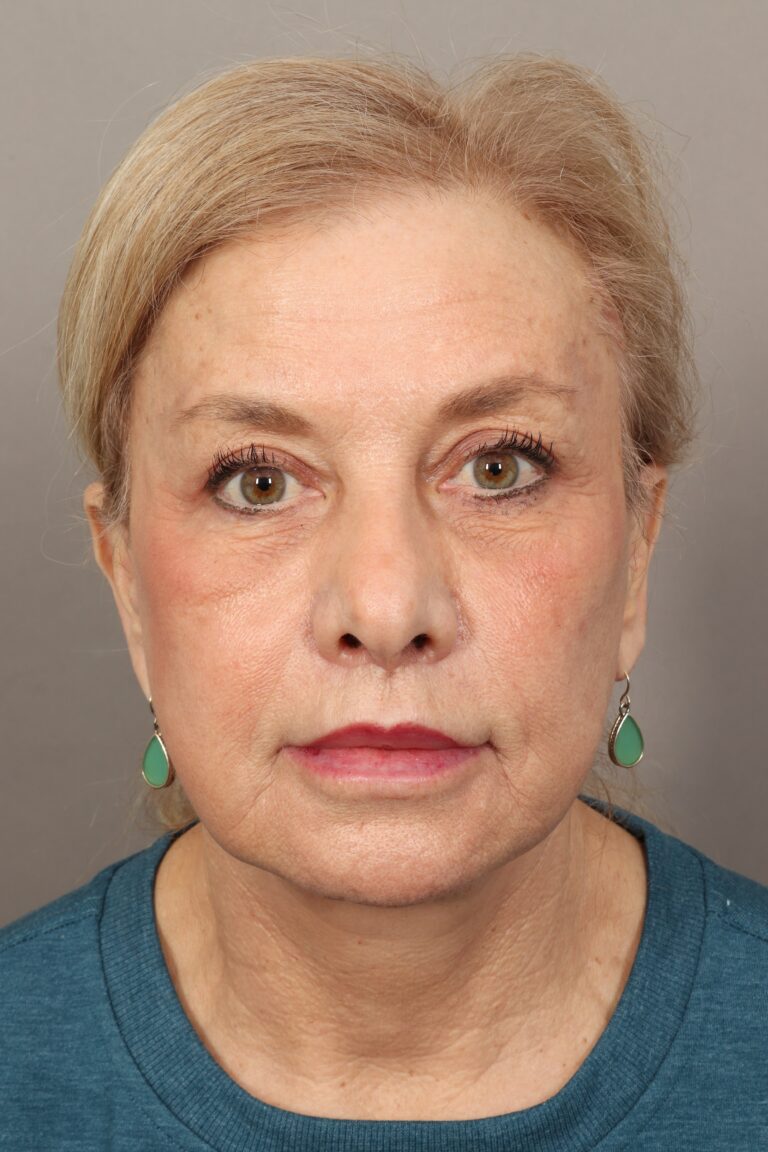 After Image: Comprehensive Facial Rejuvenation (2 Months Post-Op) - front