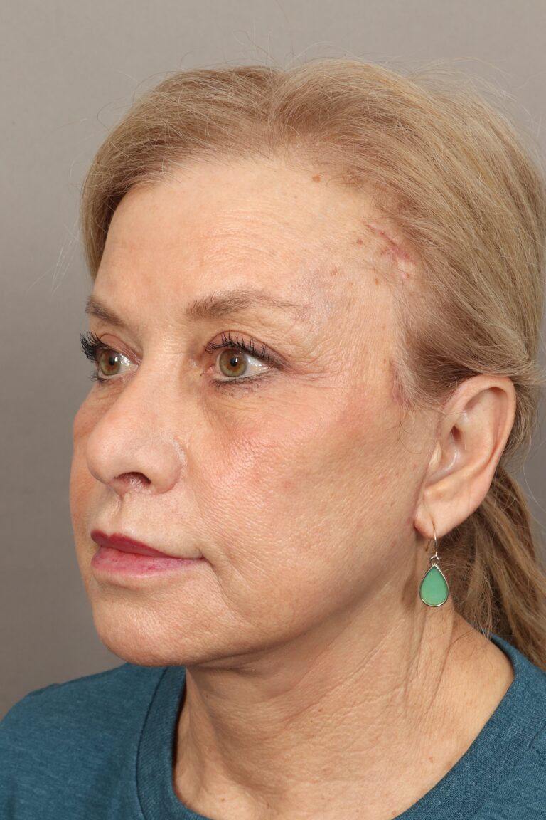 After Image: Comprehensive Facial Rejuvenation (2 Months Post-Op) - left-front-oblique