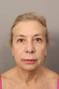 Before Image: Comprehensive Facial Rejuvenation (2 Months Post-Op)
