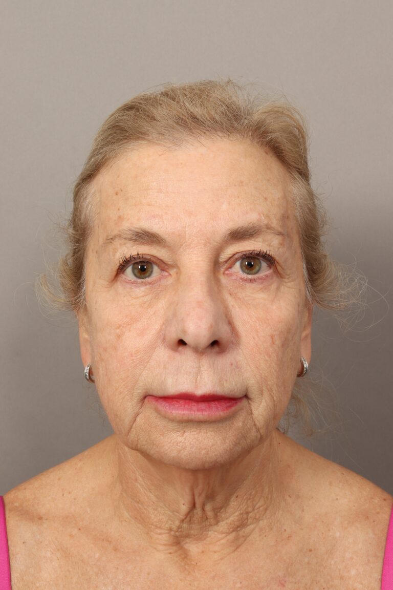 Before Image: Comprehensive Facial Rejuvenation (2 Months Post-Op) - front