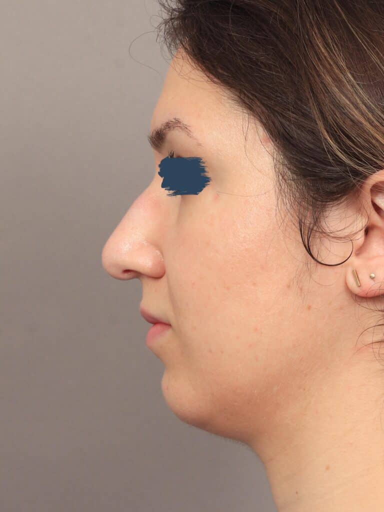 Before Image: Rhinoplasty & Genioplasty (5 Months Post-Op) - left-side