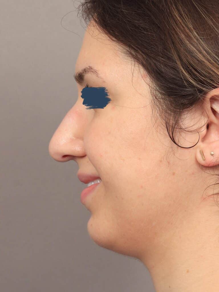 Before Image: Rhinoplasty & Genioplasty (5 Months Post-Op) - left-side
