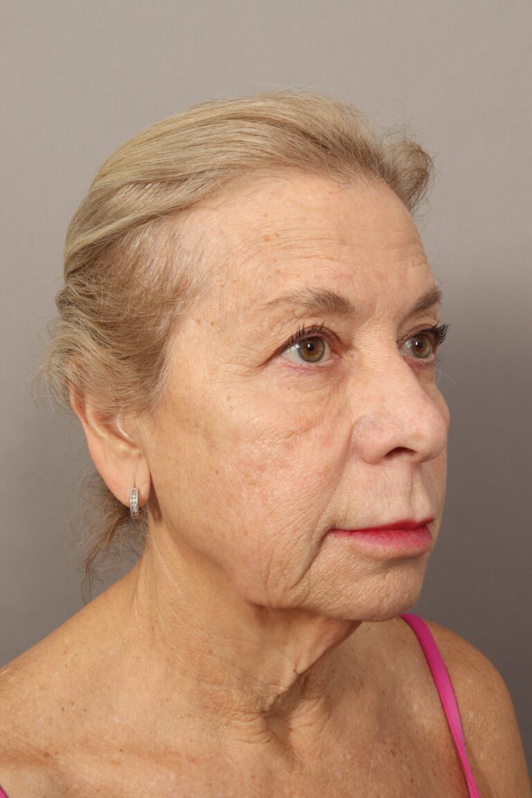 Before Image: Comprehensive Facial Rejuvenation (2 Months Post-Op) - right-front-oblique