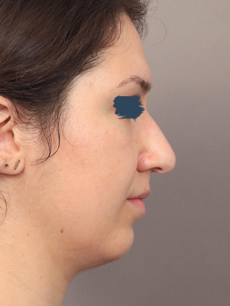 Before Image: Rhinoplasty & Genioplasty (5 Months Post-Op) - right-side
