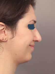 Before Image: Rhinoplasty & Genioplasty (5 Months Post-Op)