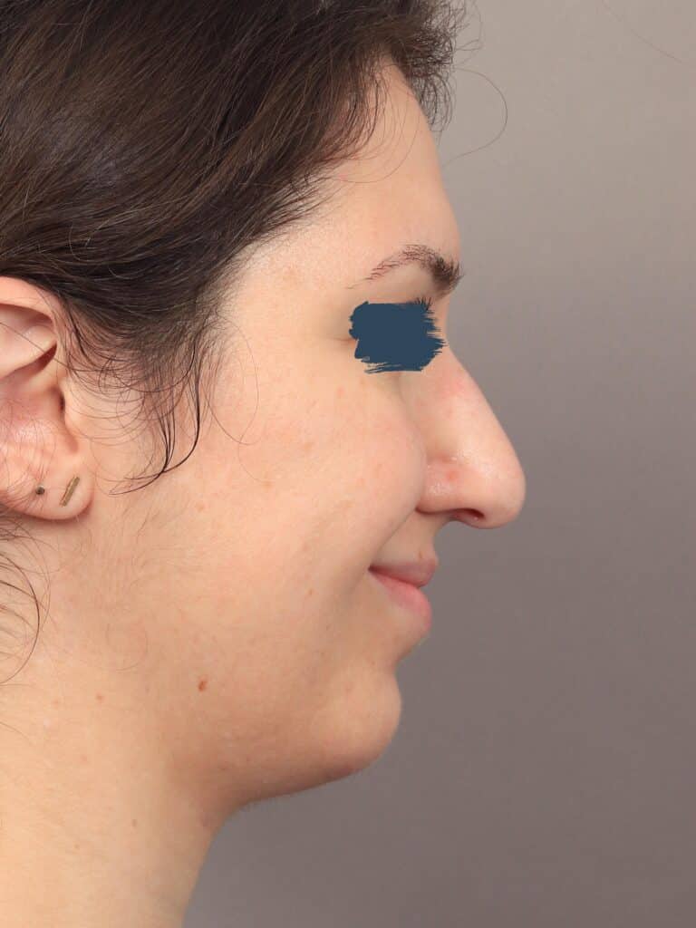 Before Image: Rhinoplasty & Genioplasty (5 Months Post-Op) - right-side
