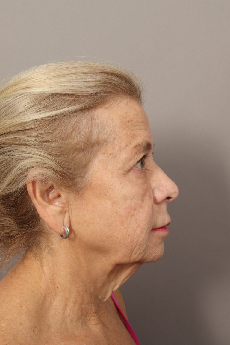 Before Image: Comprehensive Facial Rejuvenation (2 Months Post-Op) - right-side