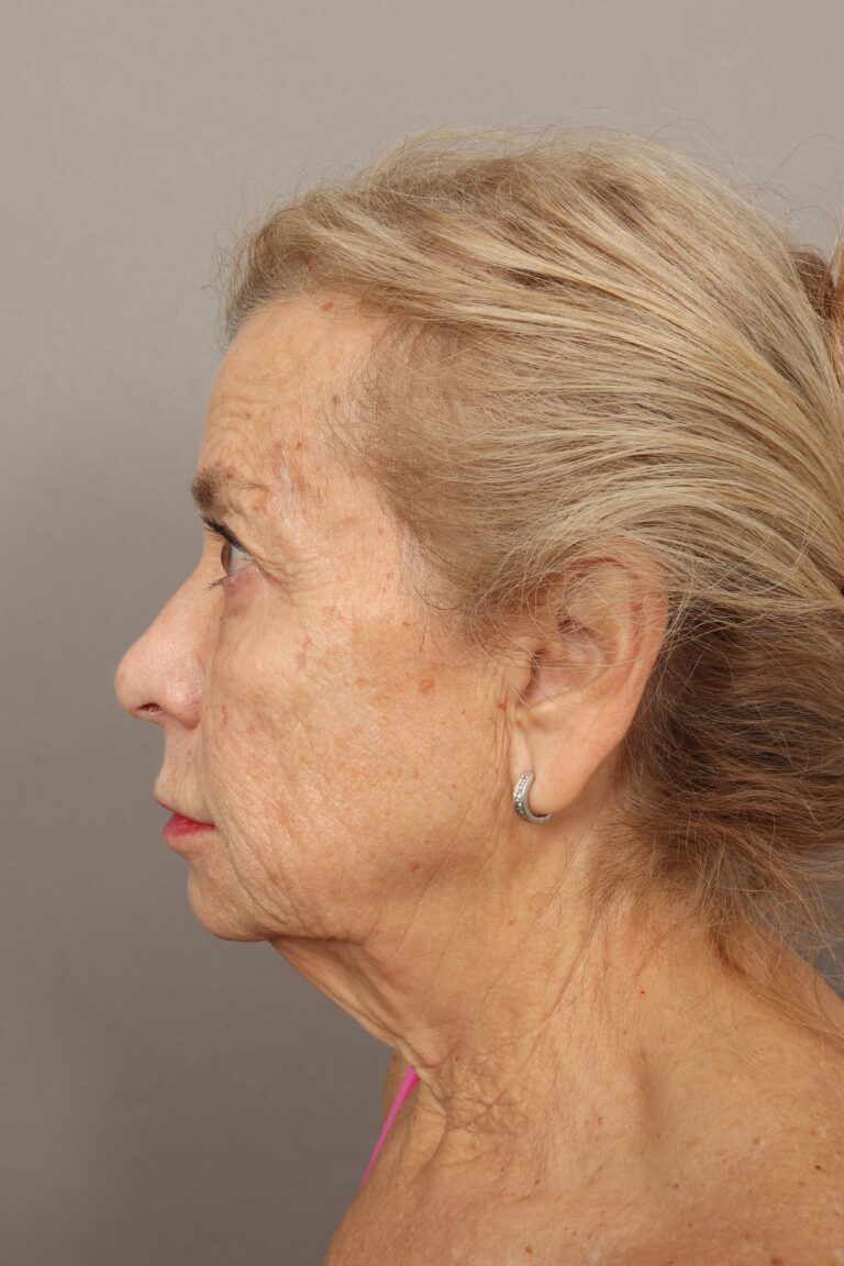 Before Image: Comprehensive Facial Rejuvenation (2 Months Post-Op) - left-side
