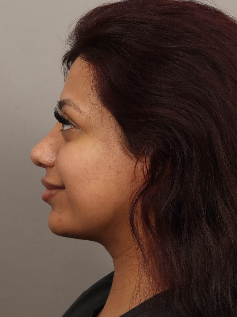 After Image: Rhinoplasty & Alarplasty (6 Months Post-Op) - left-side