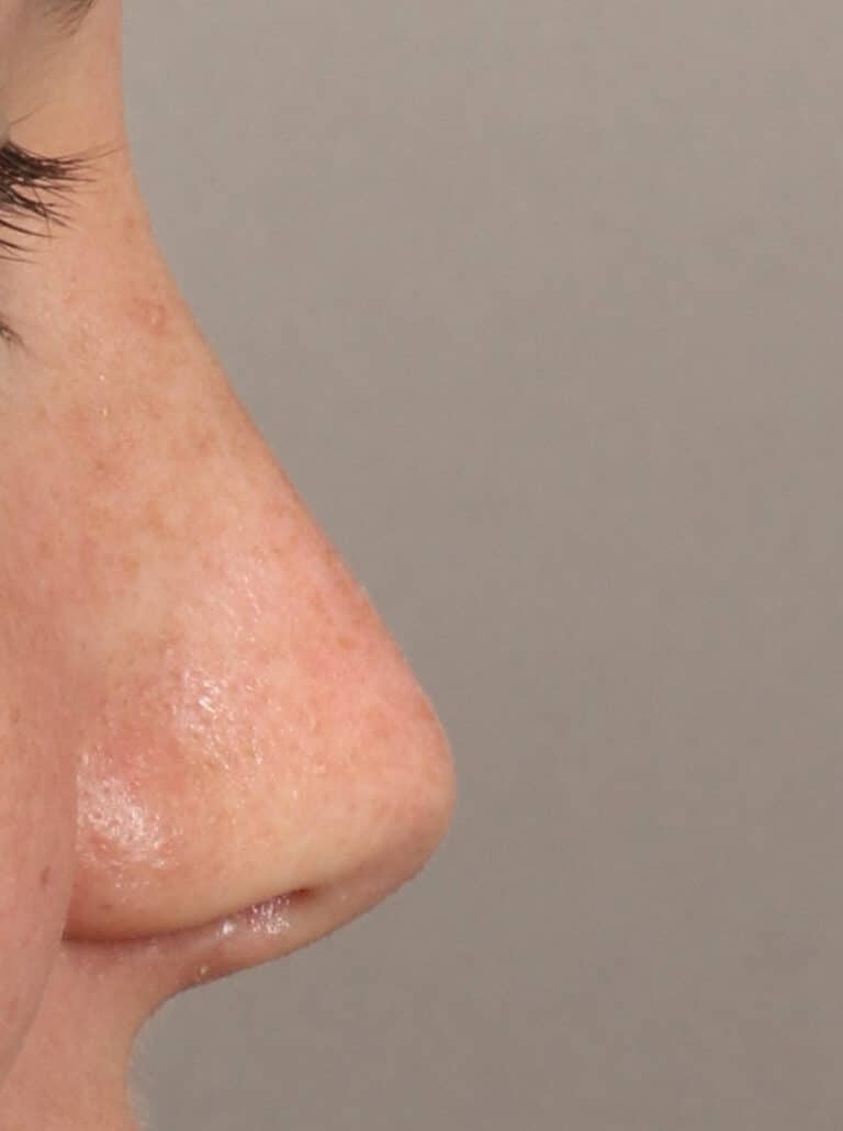 After Image: Rhinoplasty (10 Months Post-Op) - right-side