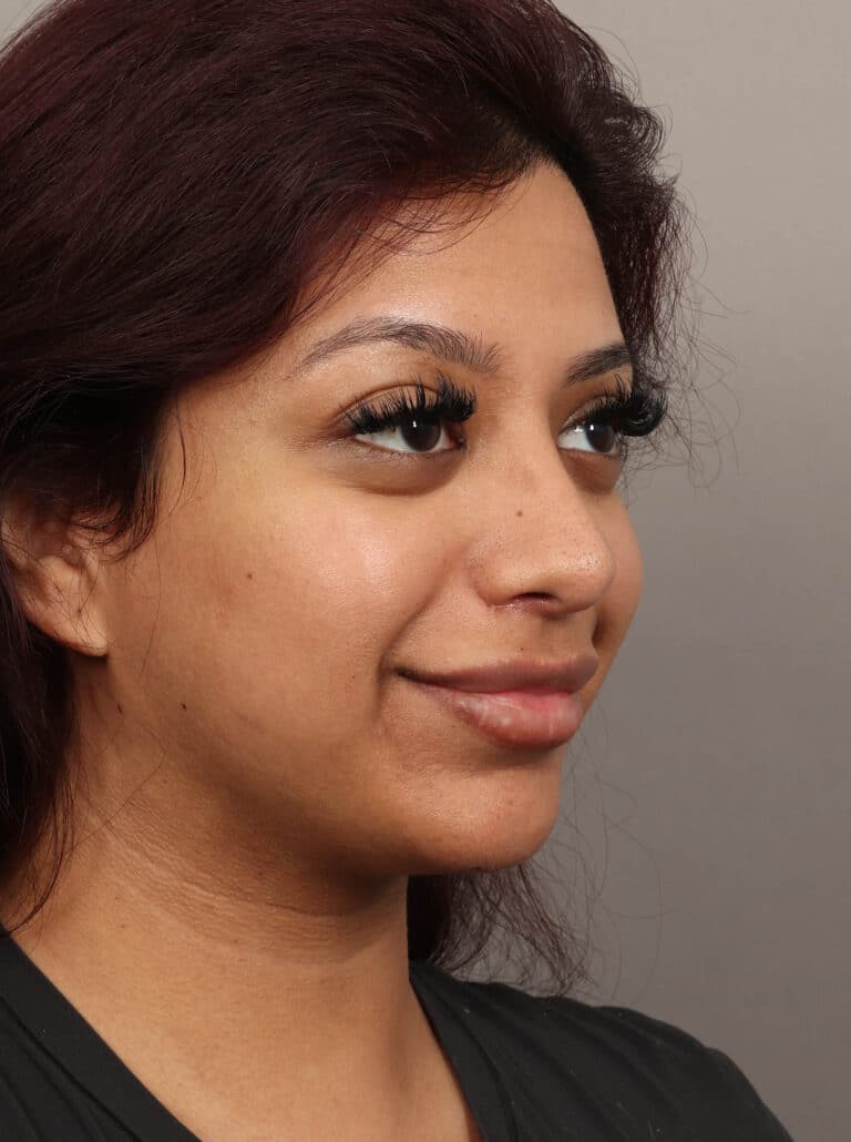 After Image: Rhinoplasty & Alarplasty (6 Months Post-Op) - right-front-oblique