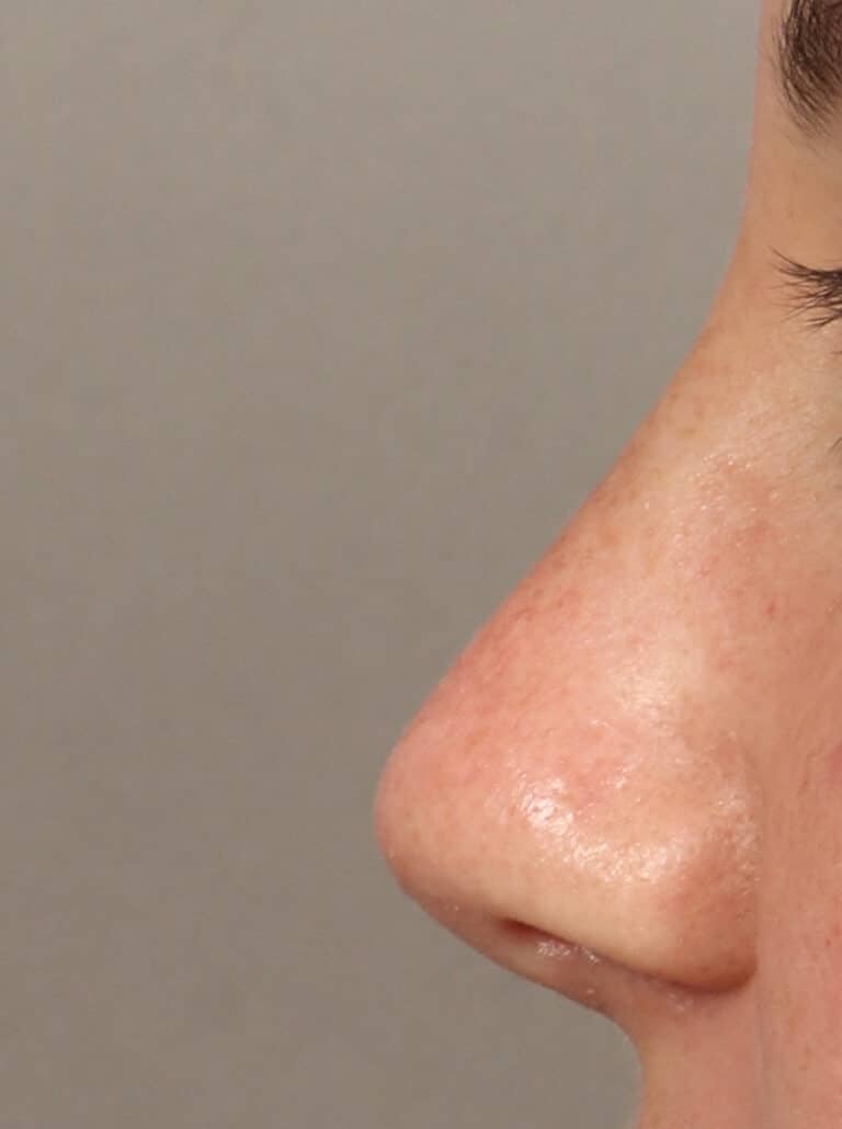 After Image: Rhinoplasty (10 Months Post-Op) - left-side