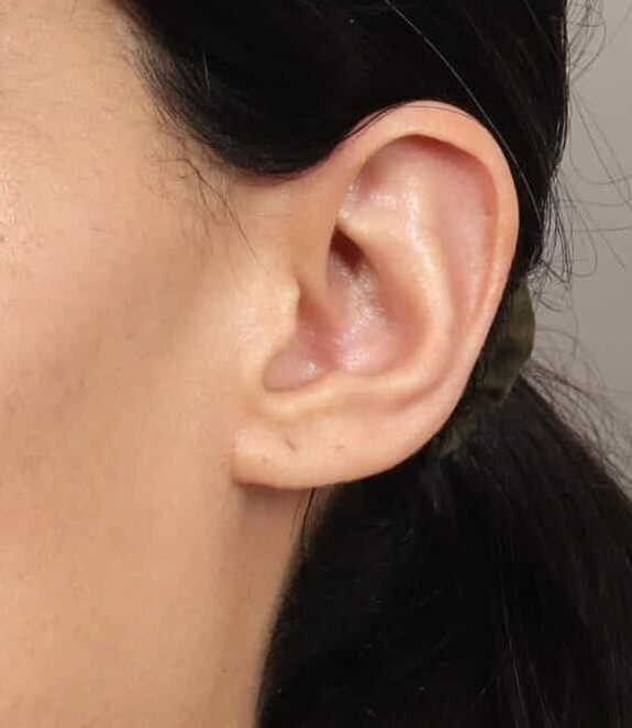 After Image: Revision Rhinoplasty (1 Month Post-Op) - left-front-oblique