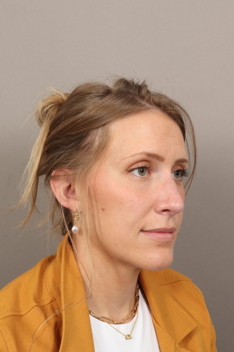 After Image: Rhinoplasty (3 Months Post-Op) - right-front-oblique
