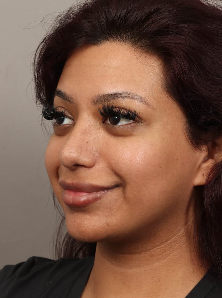 After Image: Rhinoplasty & Alarplasty (6 Months Post-Op) - left-front-oblique