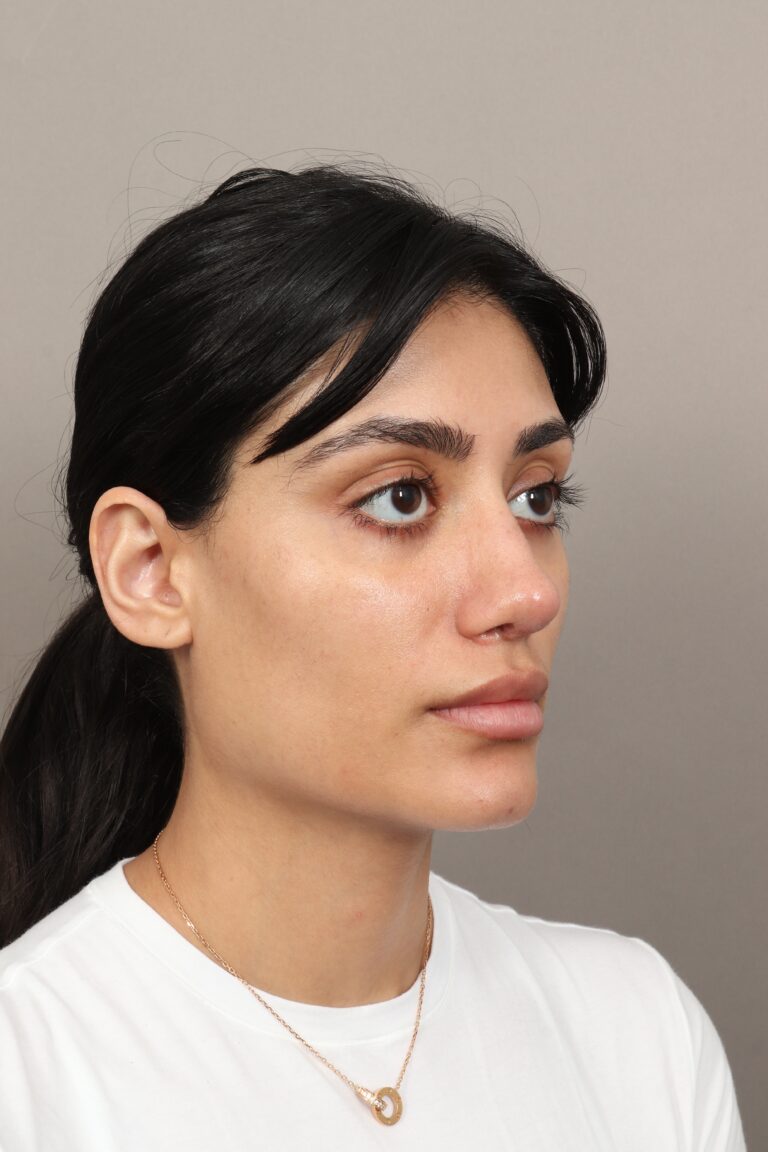 After Image: Revision Rhinoplasty (1 Month Post-Op) - right-front-oblique