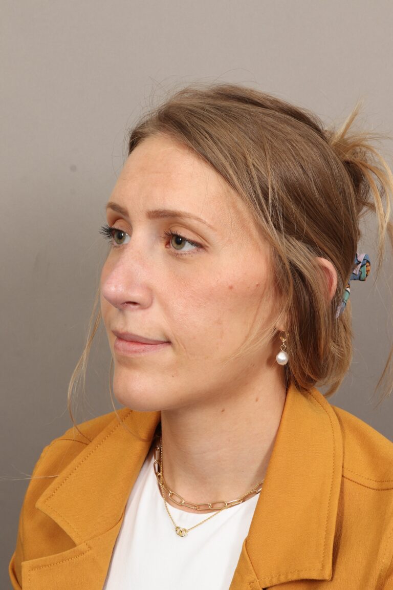 After Image: Rhinoplasty (3 Months Post-Op) - left-front-oblique