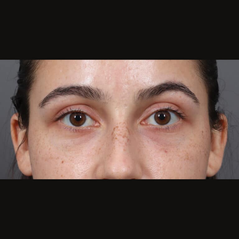 After Image: Under-Eye Filler - front