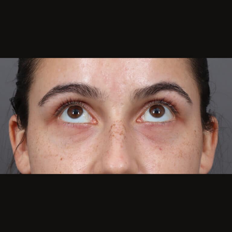 After Image: Under-Eye Filler - front