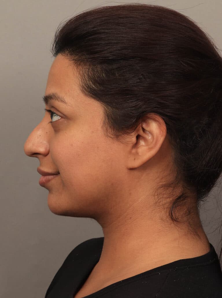 Before Image: Rhinoplasty & Alarplasty (6 Months Post-Op) - left-side