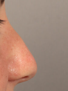 Before Image: Rhinoplasty (10 Months Post-Op)