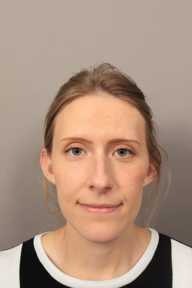 Before Image: Rhinoplasty (3 Months Post-Op) -