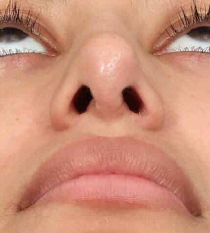 Before Image: Revision Rhinoplasty (1 Month Post-Op) - front