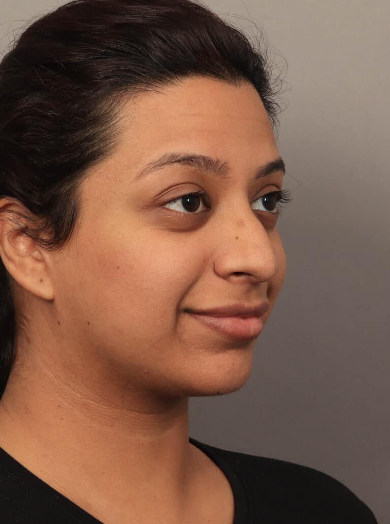 Before Image: Rhinoplasty & Alarplasty (6 Months Post-Op) - right-front-oblique